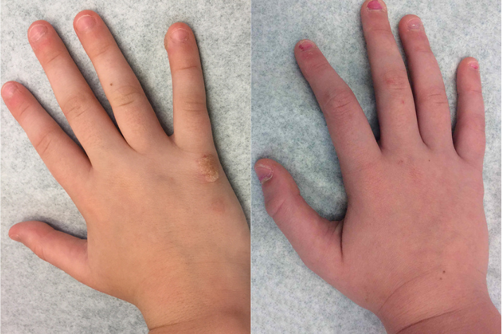 Before and after of a Male patient treated for Wart Removal with DNCB Treatment located on hand.