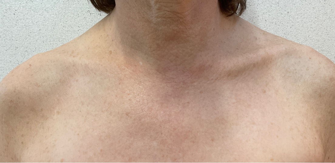 HALO Laser Chest After