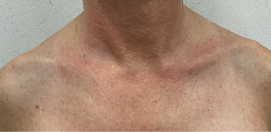 HALO Laser Chest Before