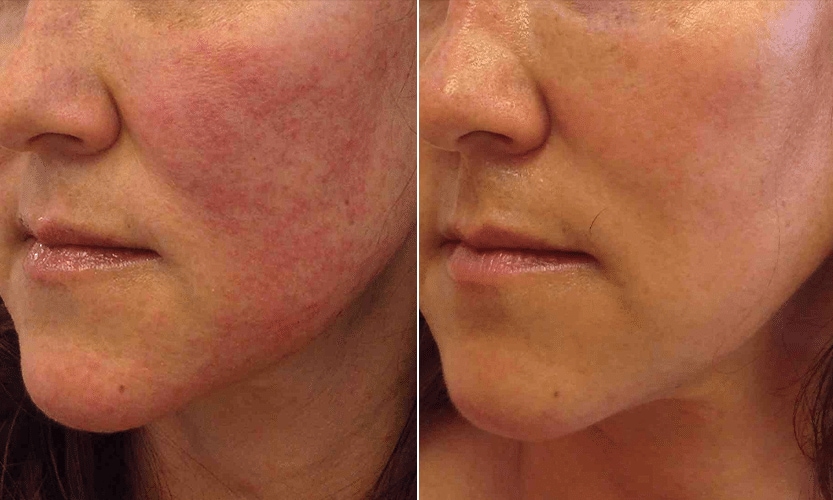 glutathione rosacea What is rosacea and how can I treat it?