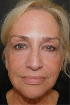 Contour TRL After Female
