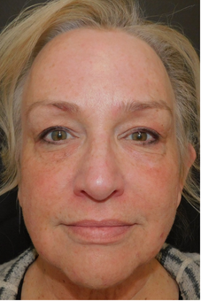 Female Contour TRL Before