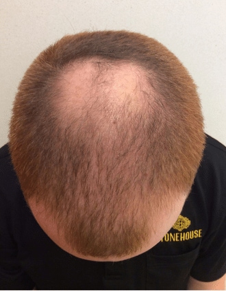 How to treat an itchy scalp | Schlessinger MD How to treat an itchy scalp | Schlessinger MD