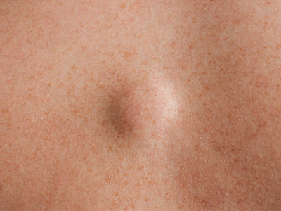 Lipoma vs. cyst: When is removal necessary?