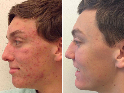 How Does Accutane Work? Board-Certified Dermatologists Explain What to Expect from Treatment