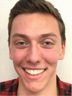 After: Acne Before and After Slider 2: After Image