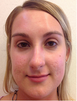 Acne Treatment Before and After Slider: After Acne Treatment Image