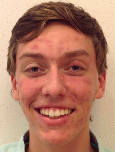 Before: Acne Before and After Slider 2: Before Image