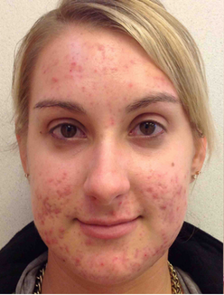 Acne Treatment Before and After Slider: Before Acne Treatment Image