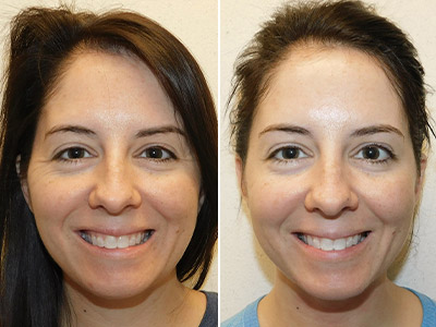 What is baby BOTOX? Understanding preventive BOTOX treatments for natural results