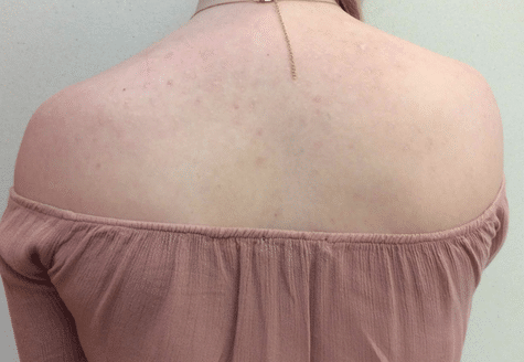 Injectables Before and After Slider: After Image