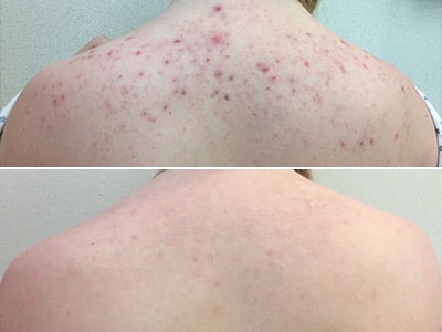 Bacne Back Acne Blog Patient Before And After Cover Image
