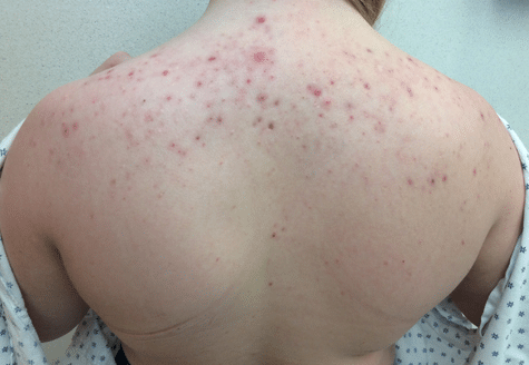 Back acne before and after image slider