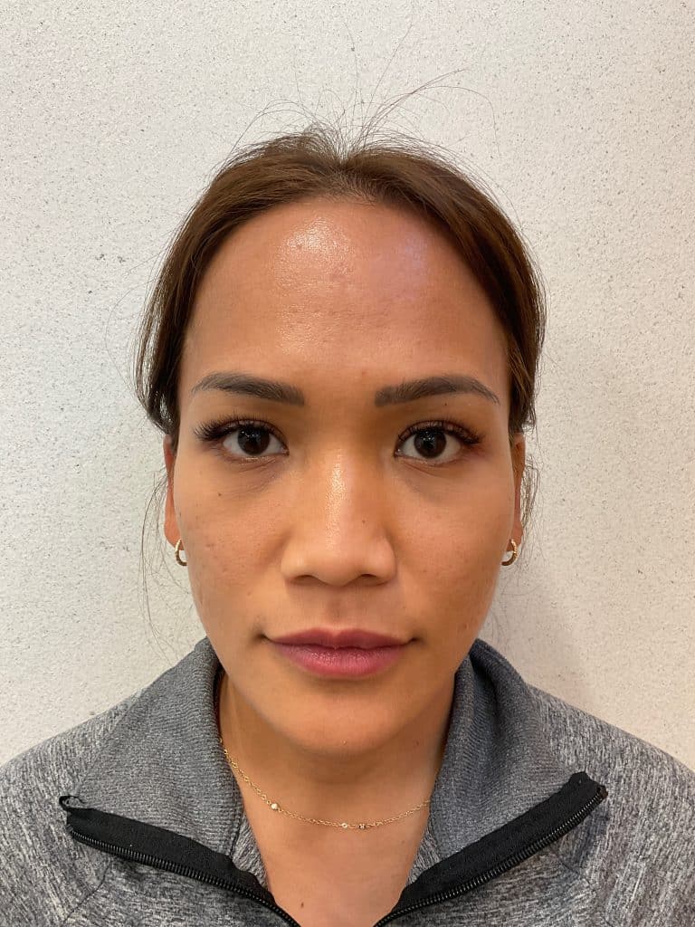 Microneedling Blog After Front
