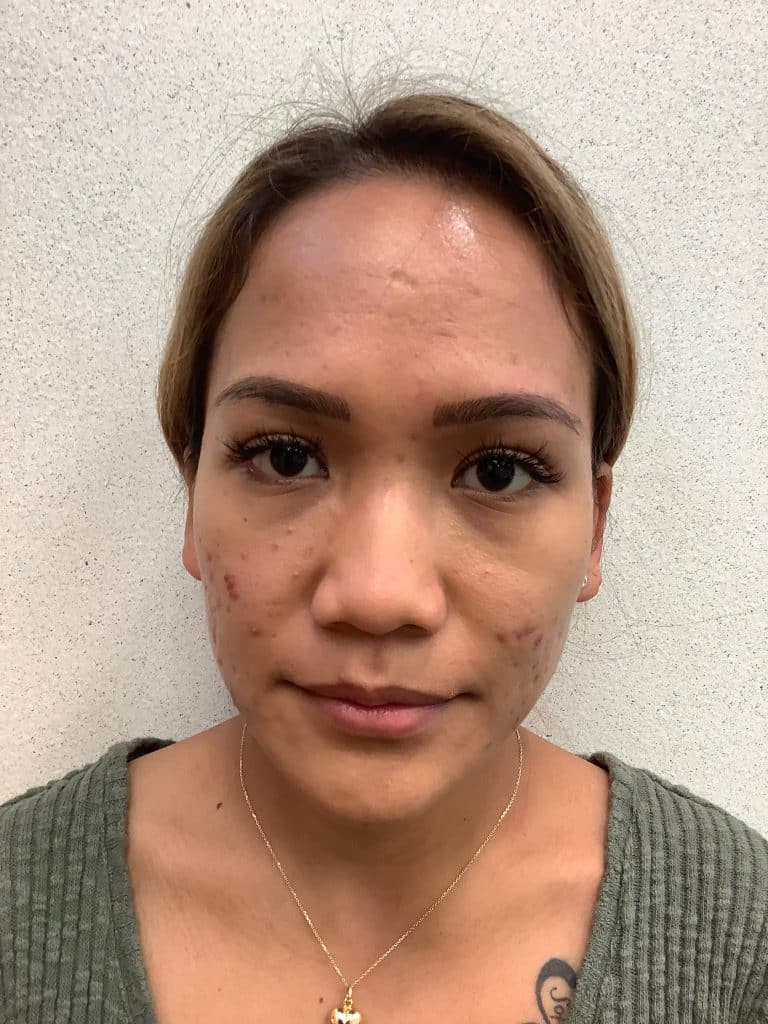 Microneedling Blog Before Front