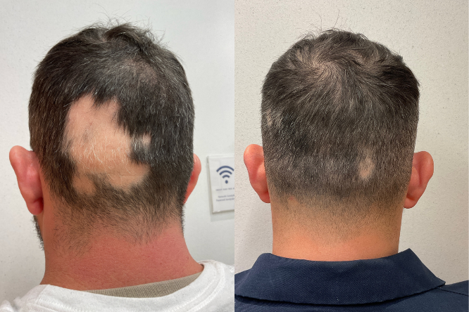 Before and after results of a 40-year-old male with severe Alopecia Areata treated by Dr. Joel Schlessinger at Schlessinger MD. Significant improvement shown after 10 months of consistent treatment with Olumiant®