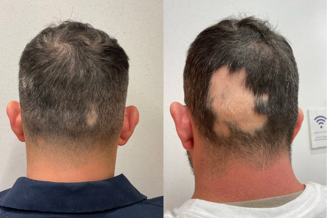 Before and after results of a 40-year-old male with severe Alopecia Areata treated by Dr. Joel Schlessinger at Schlessinger MD. Significant improvement shown after 10 months of consistent treatment with Olumiant®