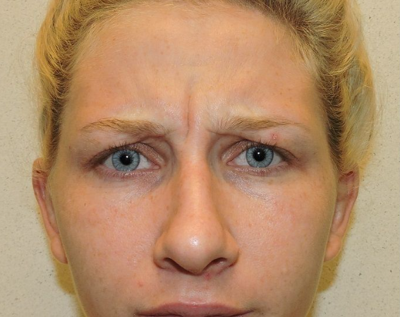 Glabellar lines study image