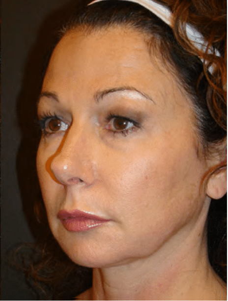 Ultherapy Skin Tightening Before and After Slider: After Image
