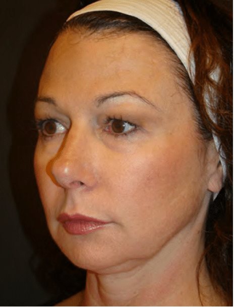 Ultherapy Skin Tightening Before and After Slider: Before Image