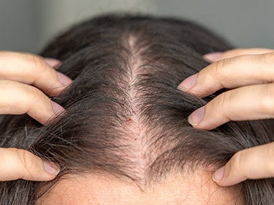 Woman parting hair in middle to display hair loss