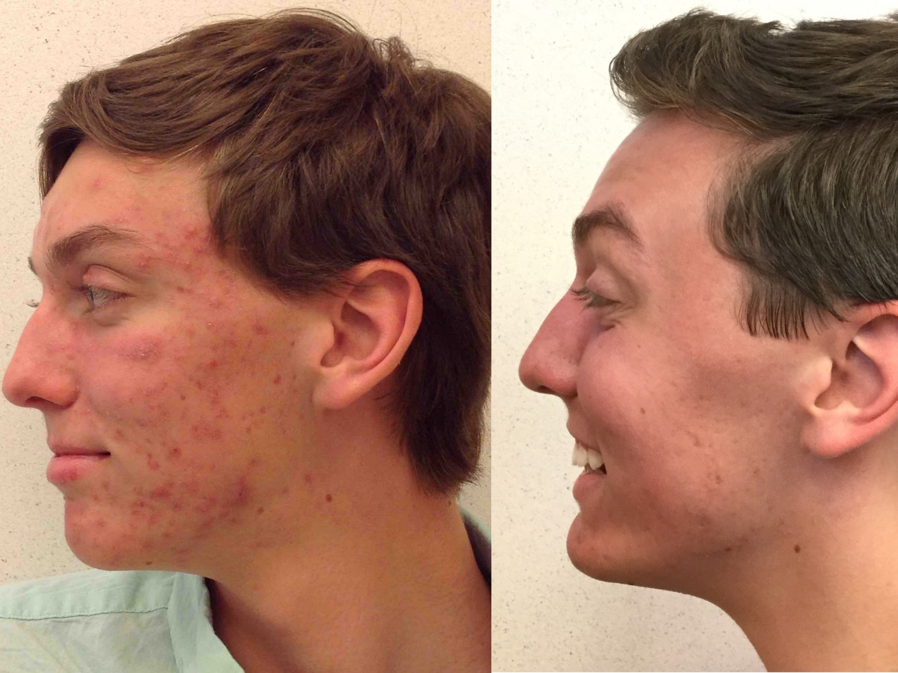 Dermatologist Acne Treatment Before and After