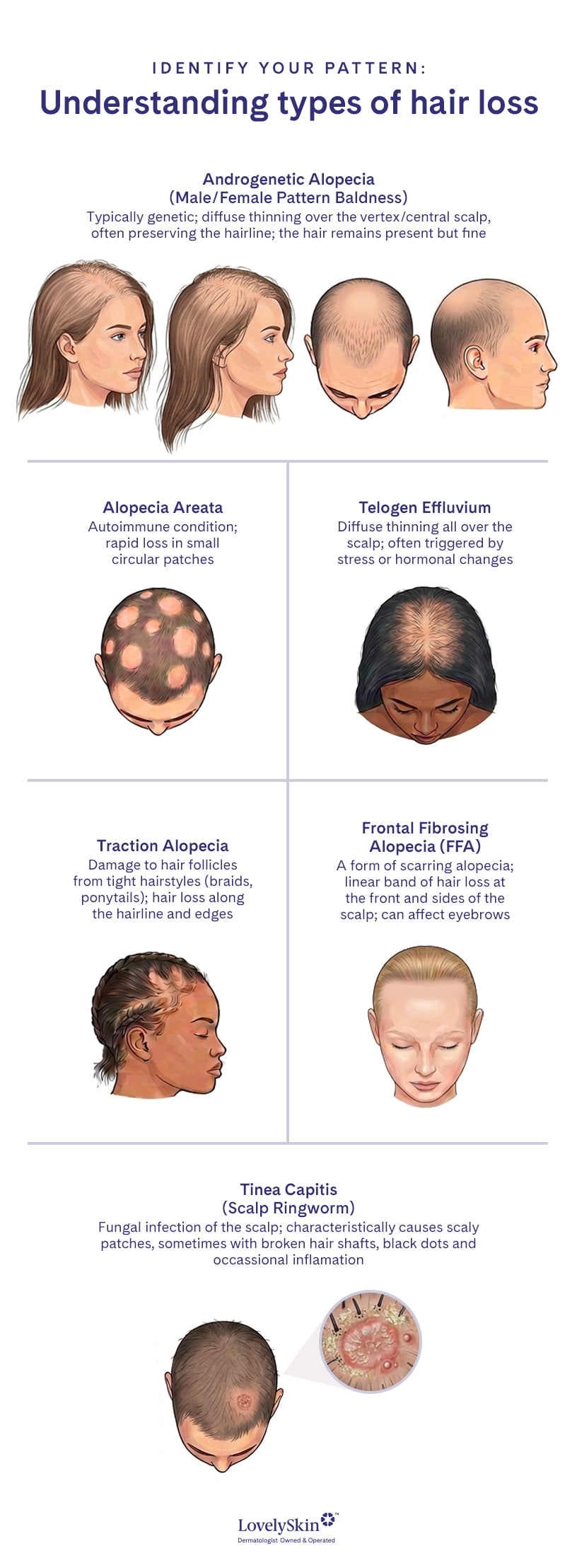 Types of hair loss infographic
