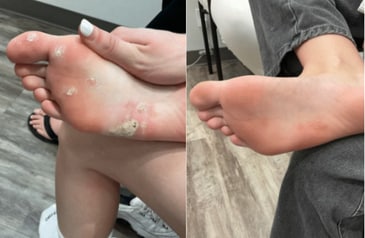 Wart Removal On Foot