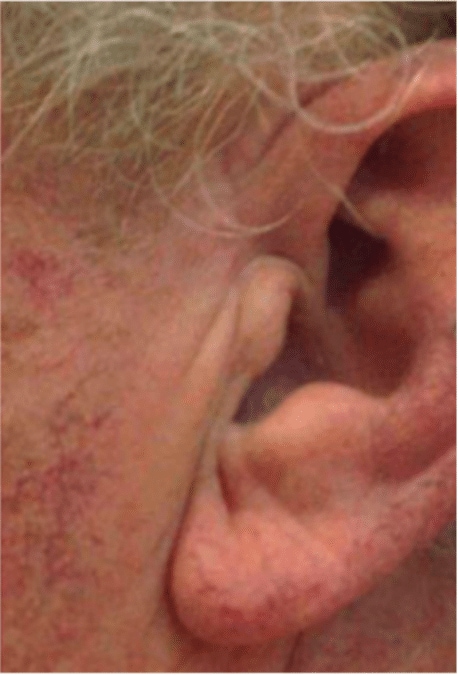 Mohs Skin Cancer Removal Before and After Slider: After Removal Image