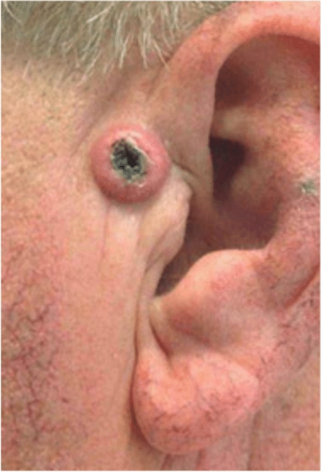 Mohs Skin Cancer Removal Before and After Slider: Before Removal Image