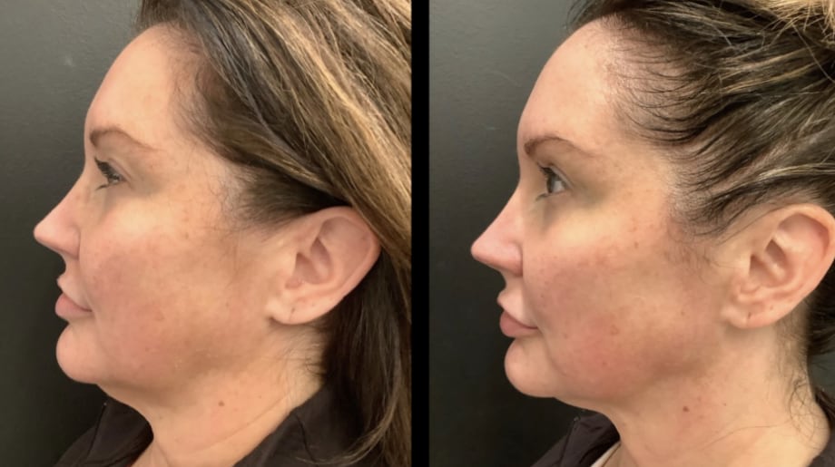 Skinpen Before and after