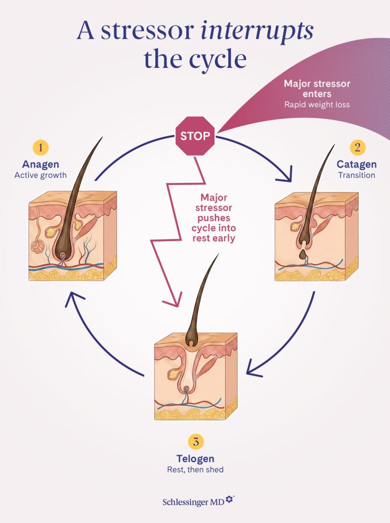 telogen effuvium stressor interrupts hair cycle inforgraphic