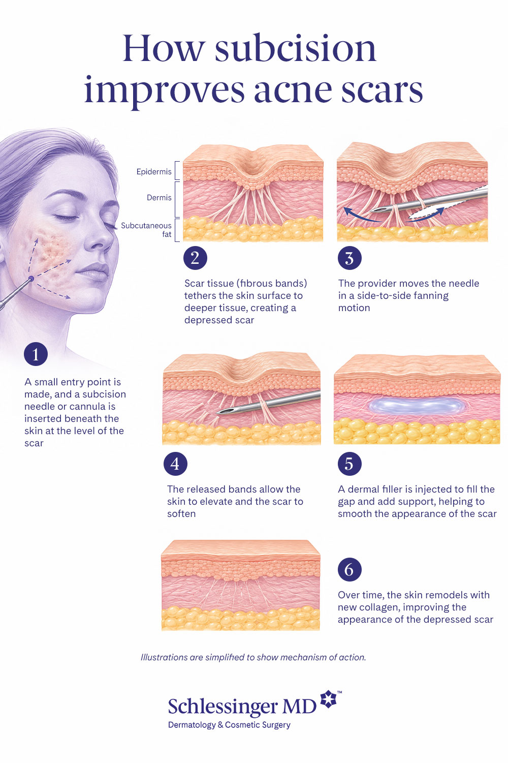 How Subcision improves acne scars graphic