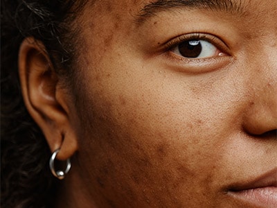 Subcision for acne scars: The specialized training behind our approach at Schlessinger MD