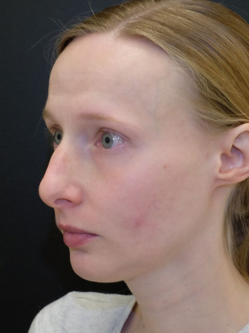 Subcision for Acne Scars Before and After Slider: After Image