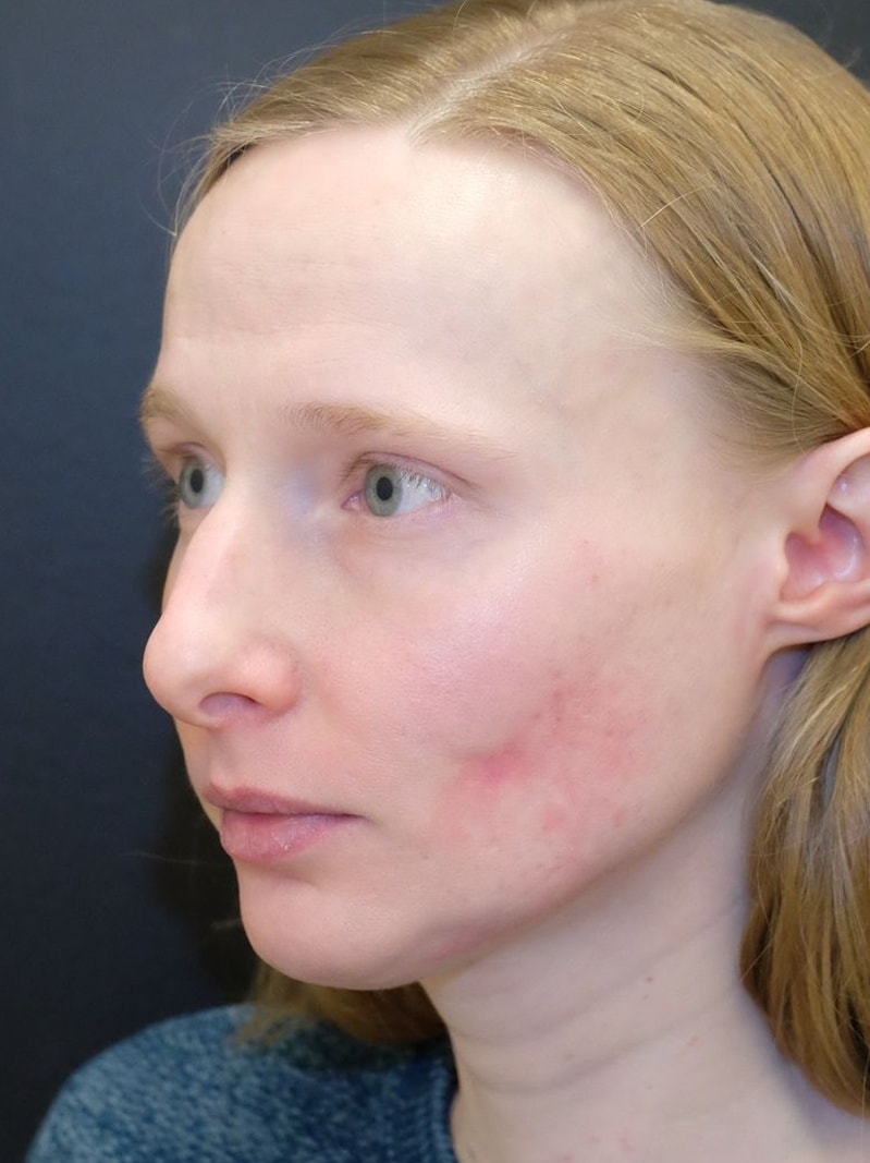 Subcision for Acne Scars Before and After Slider: Before Image